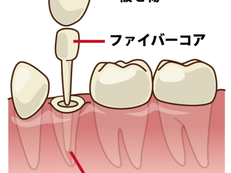 詰め物・被せ物の土台